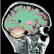 MPS Brain Segmentation with Freesurfer
