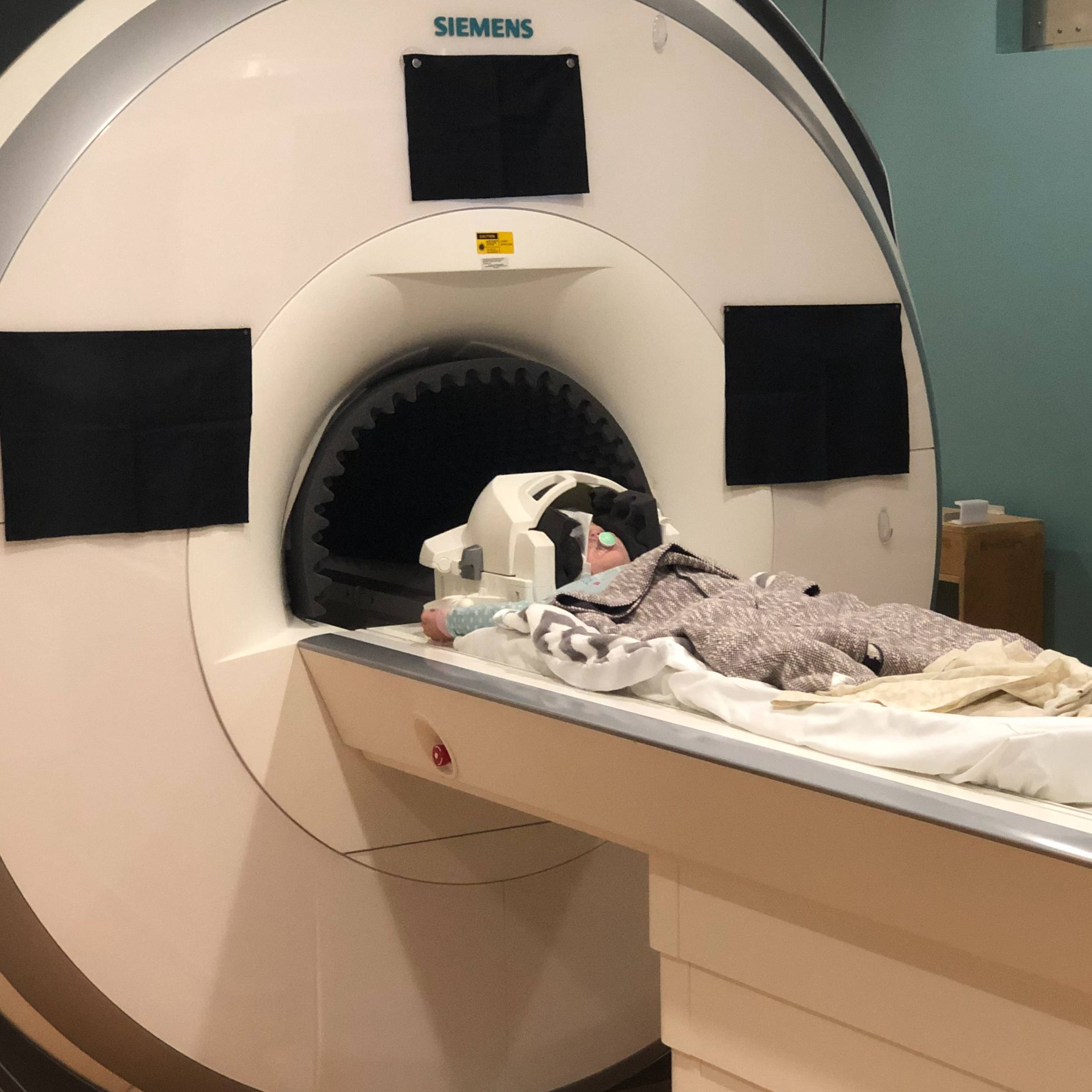 CMV Infant Study MRI Scan
