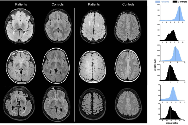 Figure of MPS affected and healthy control brain structures comparison